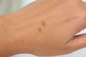 melanoma liver spots