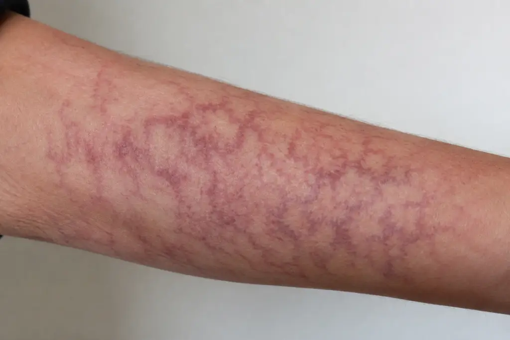 What Causes Mottled Skin and When Should You Worry