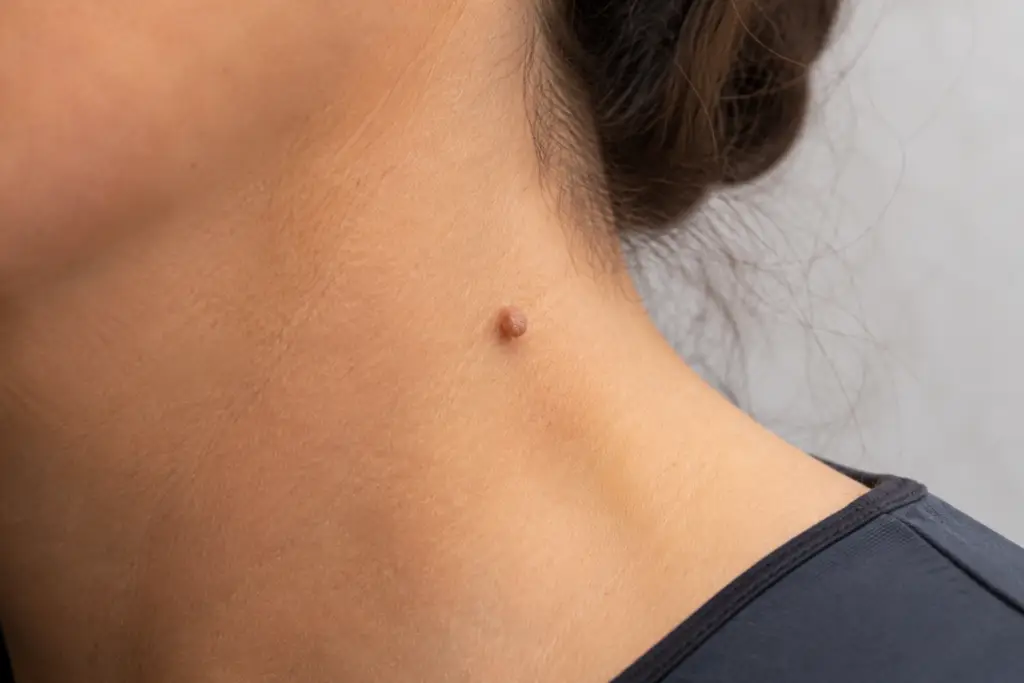 What You Need to Know About Skin Tag Removal at Home and at the Doctor