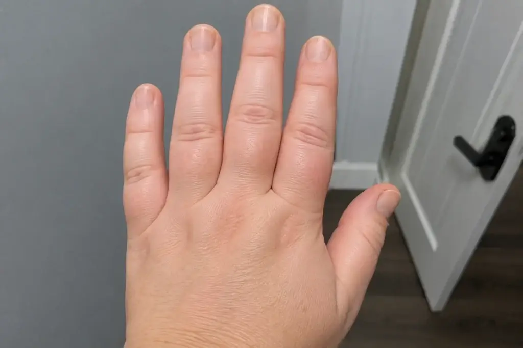 Why Your Hands Swell and How to Find Relief