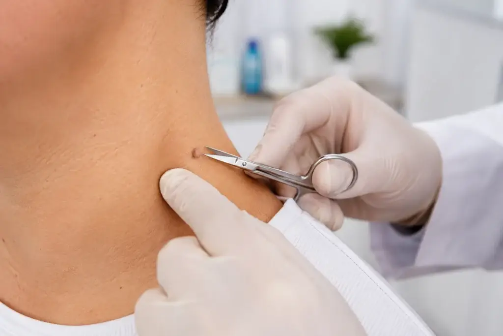 dermatologist performing professional skin tag removal procedure