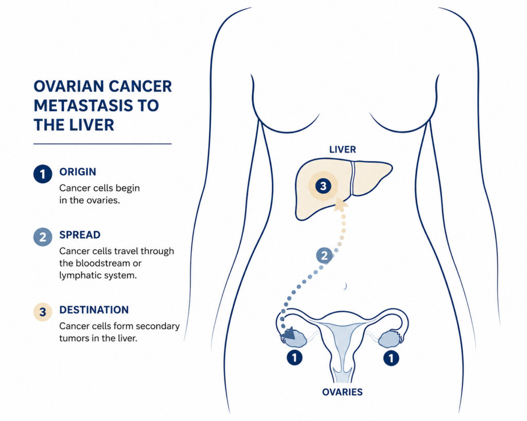 illustration of ovarian cancer spread to liver in late stage disease