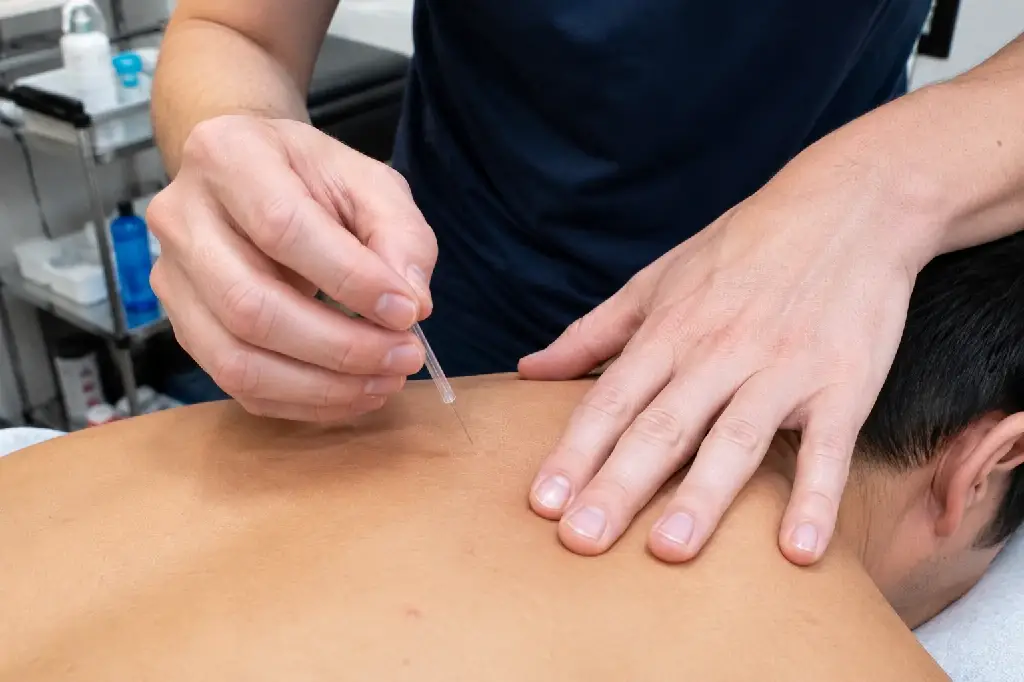 physical therapist performing dry needling on a patient's shoulder muscle