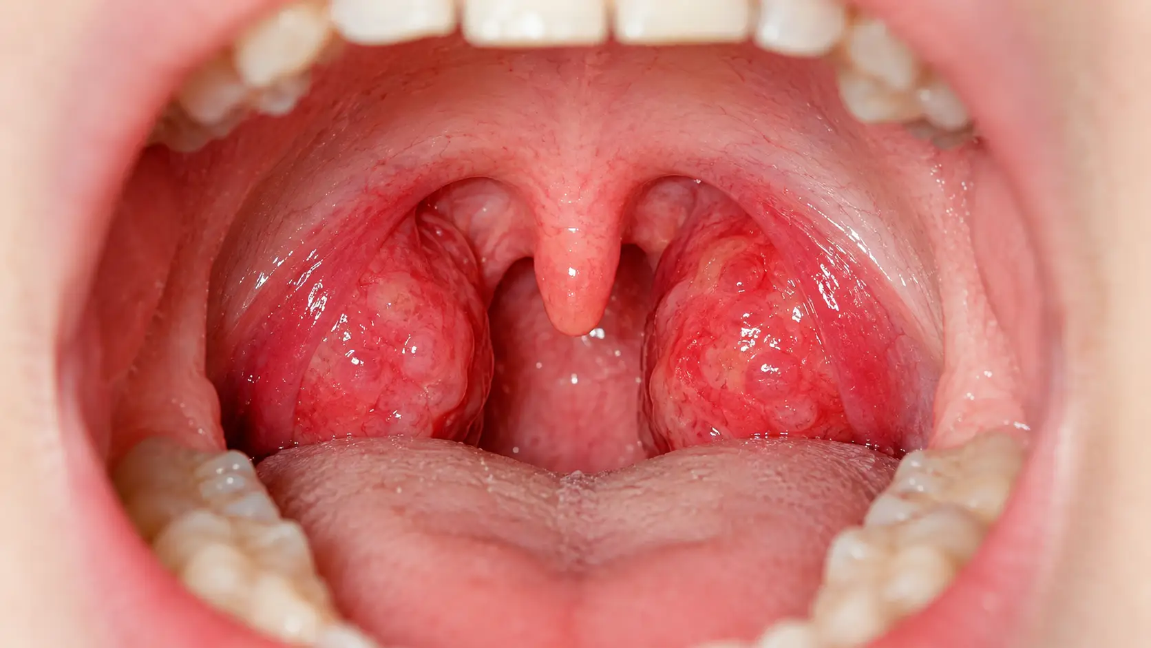 why should you remove tonsils