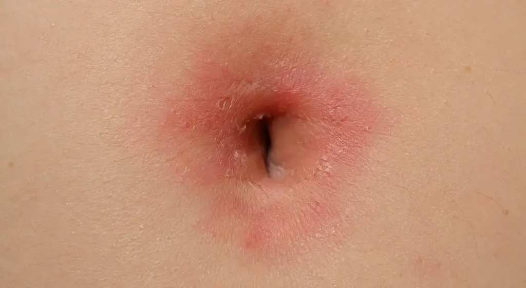 skin redness from a belly button yeast infection